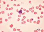 Sangue - Giemsa - Eritroblastose - 100x