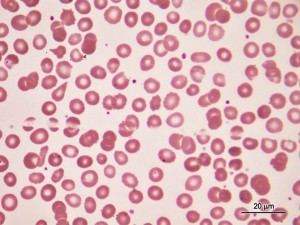 Sangue - Anemia - Giemsa - 100x